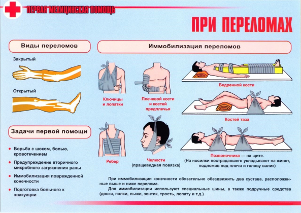 Иммобилизация при переломах различной локализации 